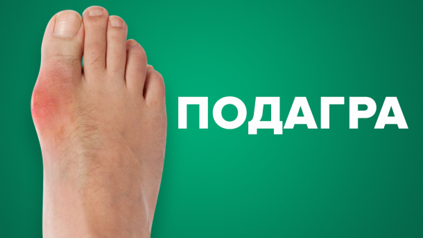 Що таке подагра: симптоми, причини та лікування хвороби