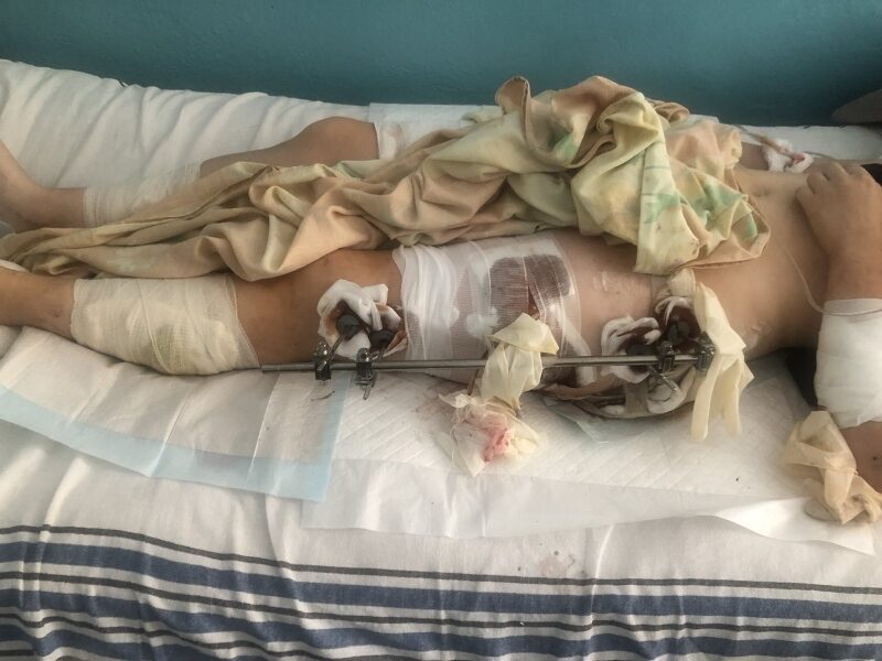 &laquo;Я&nbsp;бачила, як&nbsp;летів снаряд. Пам&rsquo;ятаю цей страшний звук. Потім запаморочення, біль&raquo;: у&nbsp;Миколаєві рятують тяжкопоранену 20-річну студентку