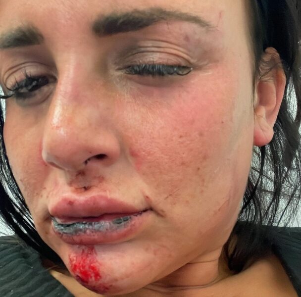 Футболіст жорстоко побив свою дівчину: щоб урятуватися, та&nbsp;вистрибнула з&nbsp;балкона (фото, відео)