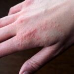 Сверблячий висип після перебування на холоді: це може бути тривожним сигналом